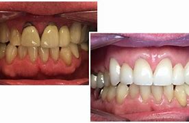 Image result for Zirconia Crown Tooth