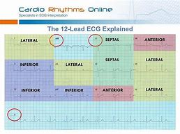 Image result for 12 Lead EKG Clip Art