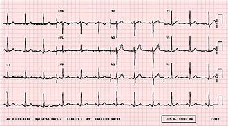 Image result for 12 Lead EKG Normal Sinus Rhythm