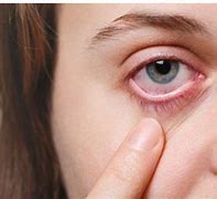 Image result for Itchy Eyes Allergies