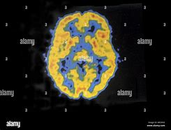 Image result for Computed Tomography Brain Scan