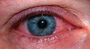 Image result for Itchy Eyes Allergies