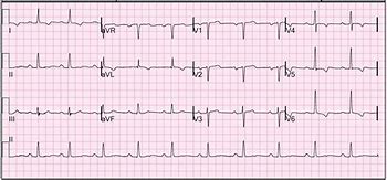 Image result for ECG Strip 12 Lead Template