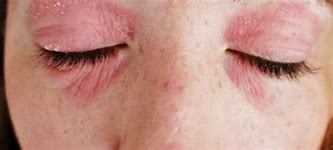 Image result for Allergic Rash around Eyes