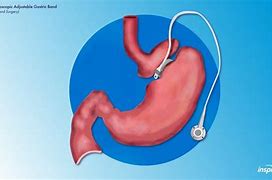 Image result for Generatic Adversial Network Laparoscopic Images