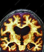 Image result for MRI Scan Alzheimer's Disease