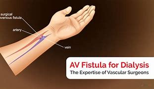 Image result for AV Fistula Dialysis