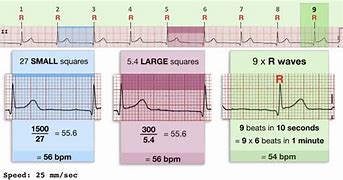 Image result for 12 Lead EKG Strip Phillips