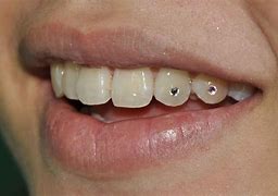 Image result for Dental Jewelry Teeth