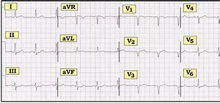 Image result for ECG Strip 12 Lead Template