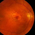 Macular Degeneration