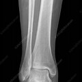 Normal Ankle Joint X-ray