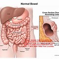 Normal Bowel Lumen Anatomy