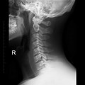 Normal Cervical Spine X-ray