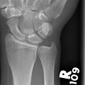 Normal Distal Radius X-ray