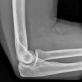 Normal Elbow Adult Epi Lateral X-ray