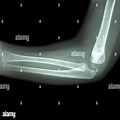 Normal Elbow X-ray in Child