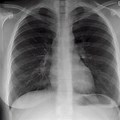 Normal Healthy Lungs X-ray