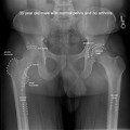 Normal Hip Joint X-ray