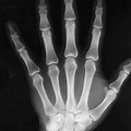 Normal Left Hand X-ray