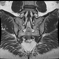 Normal Sacroiliac Joint MRI