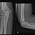 AP and Lateral Normal Elbow X-ray