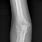 Abnormal Elbow X-ray