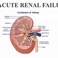 Acute Renal Failure