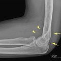 Anterior Fat Pad Sign Elbow