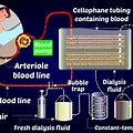 Artificial Kidney Dialysis