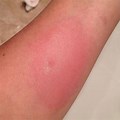 Bee Sting Reaction