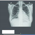 Bioprosthesis CXR Burger King Sign