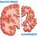 Brain Atrophy Alzheimer's Disease