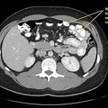 CT Abdomen Normal Bowel