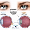 Cataract Eye Side View