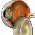 Cross Section Eye Cataract