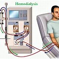 Dialysis Machine Working