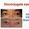 Disconjugate Eye Movement