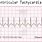 ECG of SVT