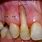 Front Teeth Roots