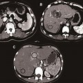 Hemangioma Liver CT vs MRI