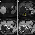 Hemangioma Liver and MRI Contrast