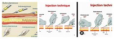 Intradermal Subcutaneous Intramuscular Injection