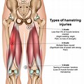 Knee Hamstring Tendon Strain