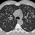 Langerhans Cell Histiocytosis CT Scan