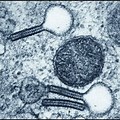 Langerhans Cell Histiocytosis Electron Microscopy