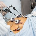 Laparoscopic Bariatric Surgery