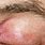 Rash around Eyes and Eyelids