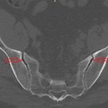 Sacroiliac Joint CT Scan