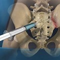 Sacroiliac Joint Steroid Injection